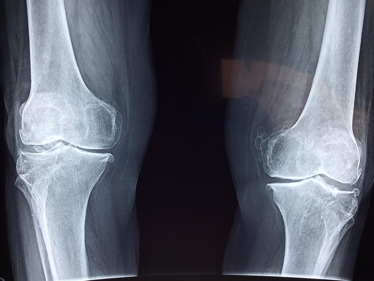 Bone Health in Adolescents