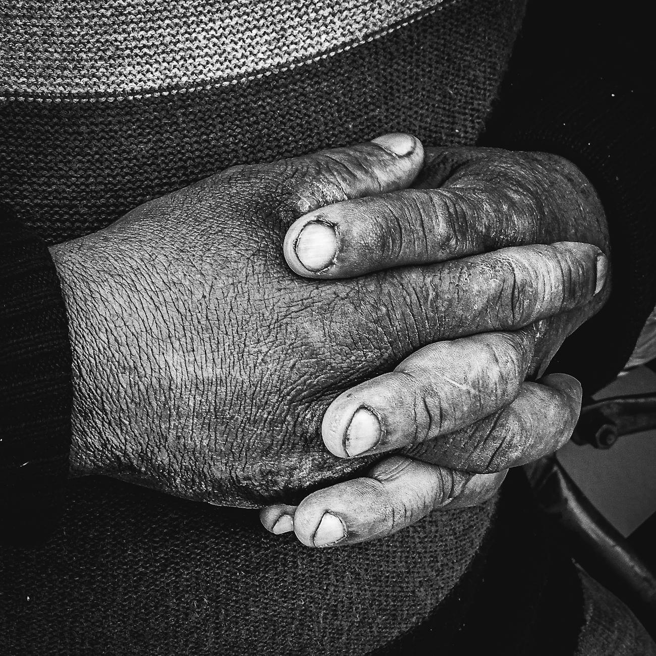 Common Conditions Affecting the Hands in Elderly Clients