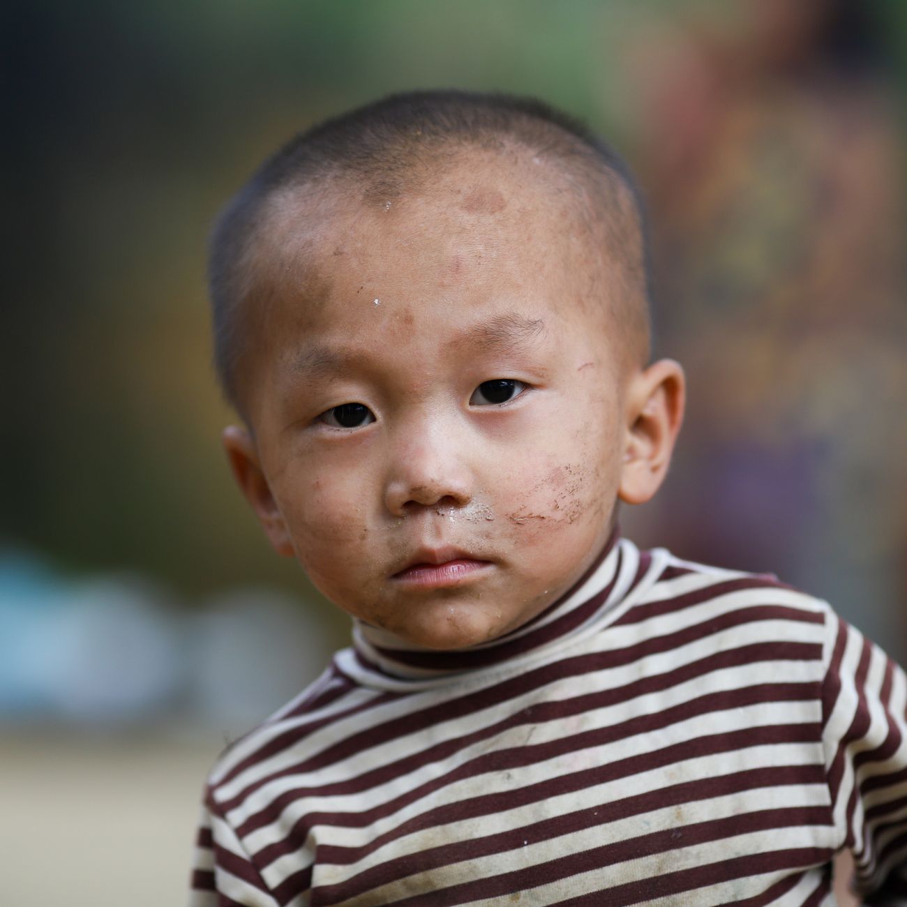 Management of Severe Acute Malnutrition